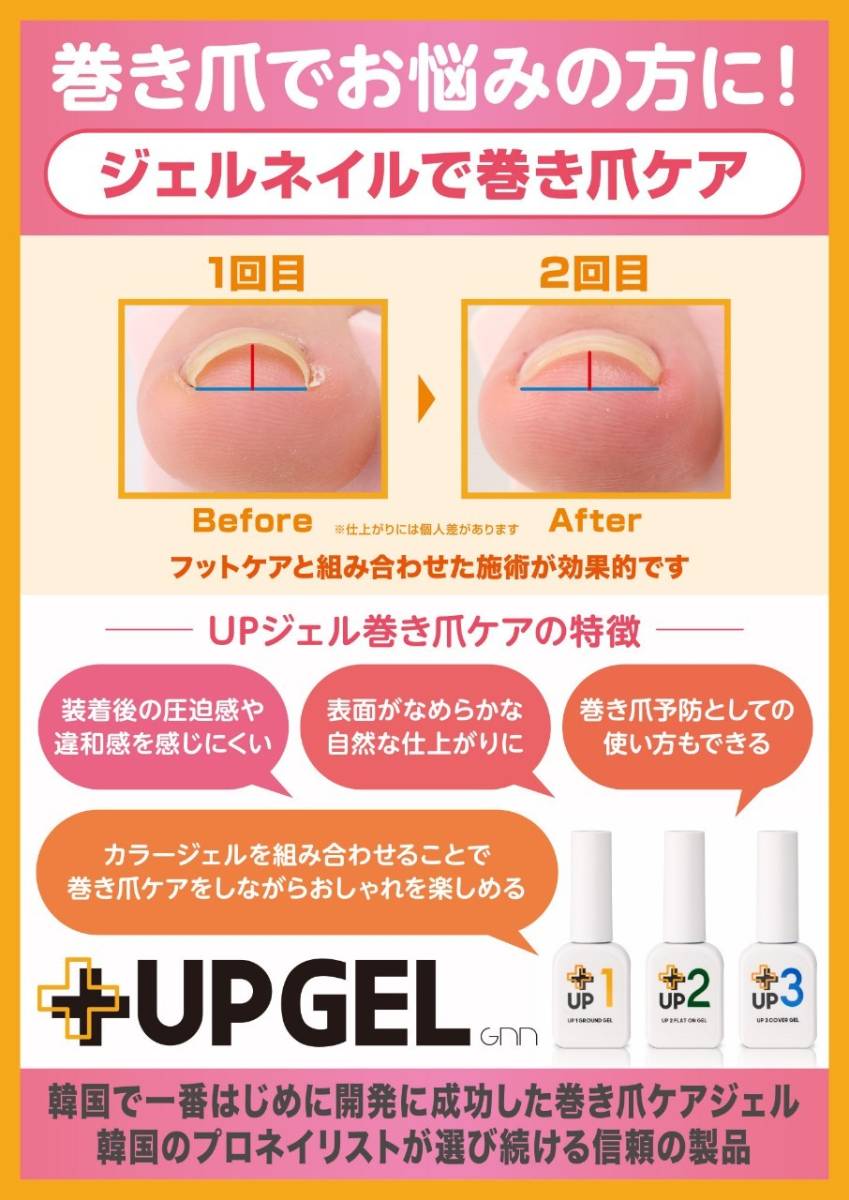 巻き爪のケア – UPGEL - 美足のすゝめ - footcarelist shu